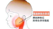 腮腺炎的早期症状,识别与预防关键